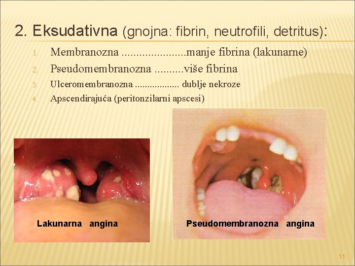 2. Eksudativna (gnojna: fibrin, neutrofili, detritus): 1. 2. 3. 4. Membranozna. . . . 2. Eksudativna (gnojna: fibrin, neutrofili, detritus): 1. 2. 3. 4. Membranozna. . . .
