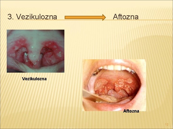 3. Vezikulozna Aftozna 12 3. Vezikulozna Aftozna 12