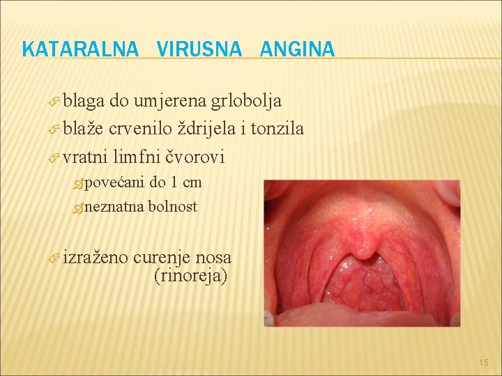 KATARALNA VIRUSNA ANGINA blaga do umjerena grlobolja blaže crvenilo ždrijela i tonzila vratni limfni KATARALNA VIRUSNA ANGINA blaga do umjerena grlobolja blaže crvenilo ždrijela i tonzila vratni limfni