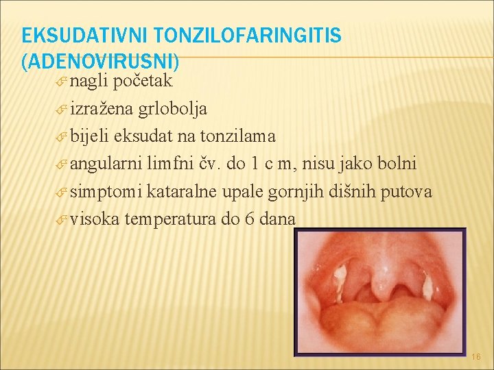 EKSUDATIVNI TONZILOFARINGITIS (ADENOVIRUSNI) nagli početak izražena grlobolja bijeli eksudat na tonzilama angularni limfni čv. EKSUDATIVNI TONZILOFARINGITIS (ADENOVIRUSNI) nagli početak izražena grlobolja bijeli eksudat na tonzilama angularni limfni čv.