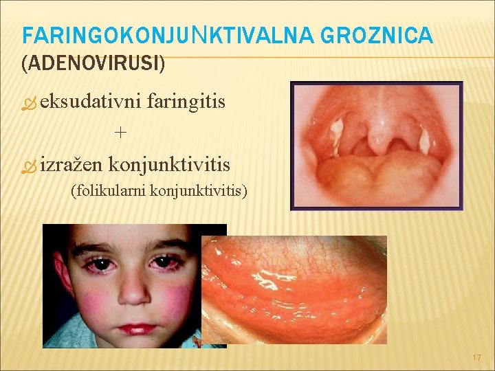 FARINGOKONJUNKTIVALNA GROZNICA (ADENOVIRUSI) eksudativni faringitis + izražen konjunktivitis (folikularni konjunktivitis) 17 FARINGOKONJUNKTIVALNA GROZNICA (ADENOVIRUSI) eksudativni faringitis + izražen konjunktivitis (folikularni konjunktivitis) 17