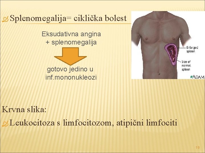 Splenomegalija= ciklička bolest Eksudativna angina + splenomegalija gotovo jedino u inf. mononukleozi Krvna Splenomegalija= ciklička bolest Eksudativna angina + splenomegalija gotovo jedino u inf. mononukleozi Krvna