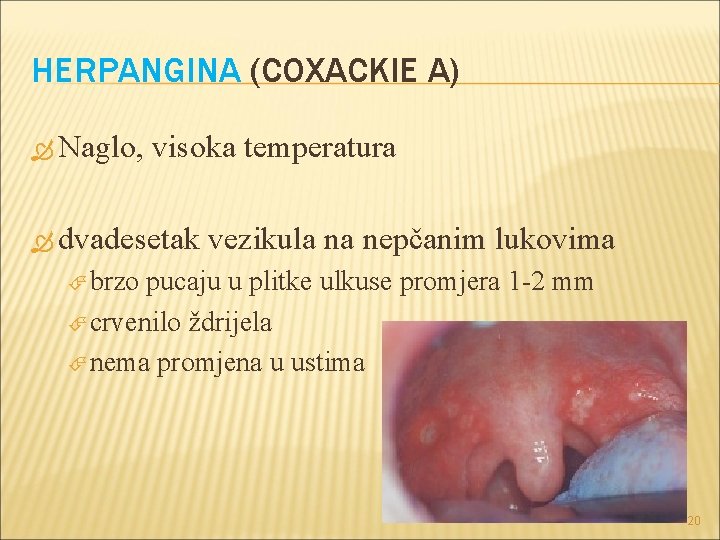 HERPANGINA (COXACKIE A) Naglo, visoka temperatura dvadesetak vezikula na nepčanim lukovima brzo pucaju u HERPANGINA (COXACKIE A) Naglo, visoka temperatura dvadesetak vezikula na nepčanim lukovima brzo pucaju u