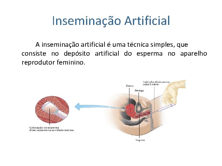 Inseminação Artificial A inseminação artificial é uma técnica simples, que consiste no depósito artificial