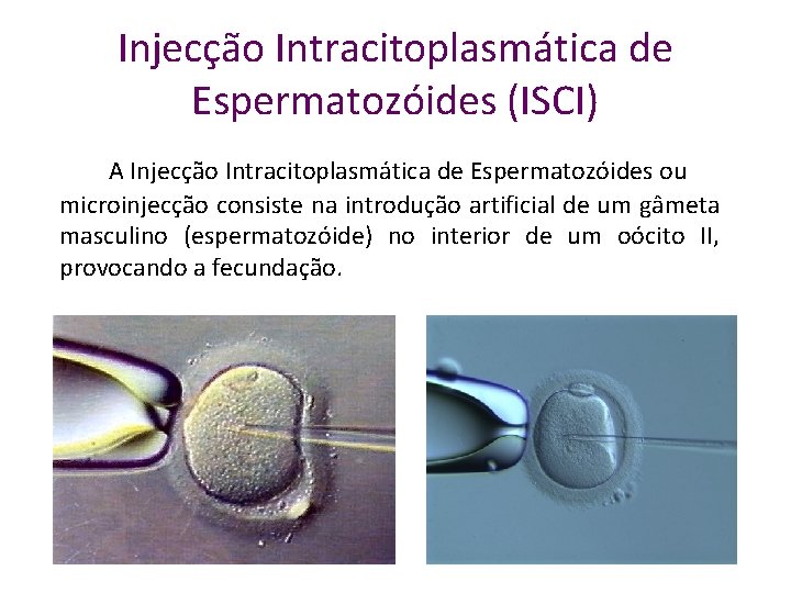 Injecção Intracitoplasmática de Espermatozóides (ISCI) A Injecção Intracitoplasmática de Espermatozóides ou microinjecção consiste na