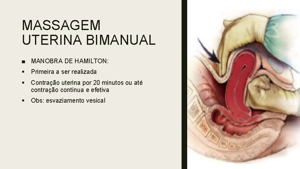 MASSAGEM UTERINA BIMANUAL ■ MANOBRA DE HAMILTON: § Primeira a ser realizada § Contração