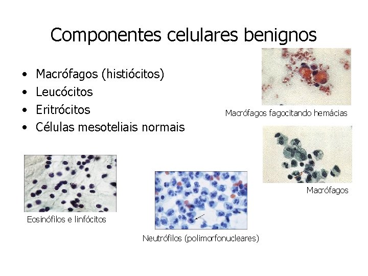 Componentes celulares benignos • • Macrófagos (histiócitos) Leucócitos Eritrócitos Células mesoteliais normais Macrófagos fagocitando