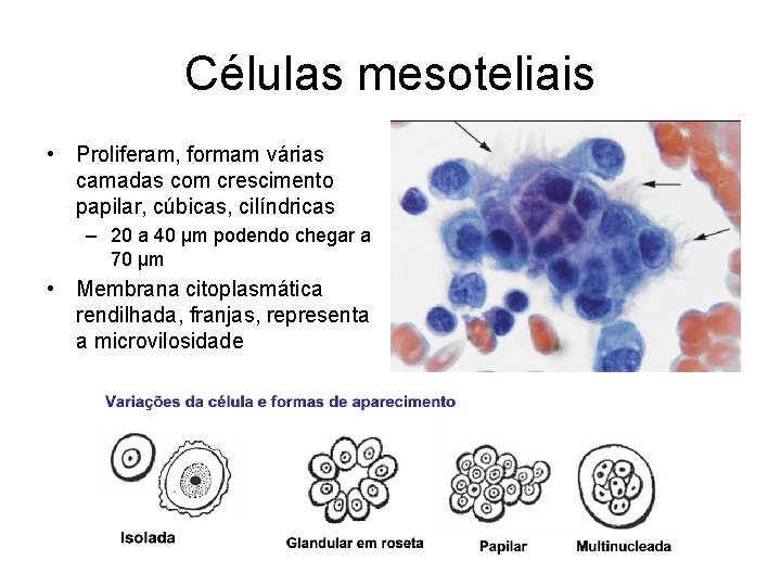 Células mesoteliais • Proliferam, formam várias camadas com crescimento papilar, cúbicas, cilíndricas – 20
