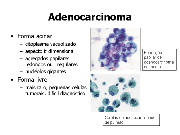 Adenocarcinoma • Forma acinar – citoplasma vacuolizado – aspecto tridimensional – agregados papilares redondos