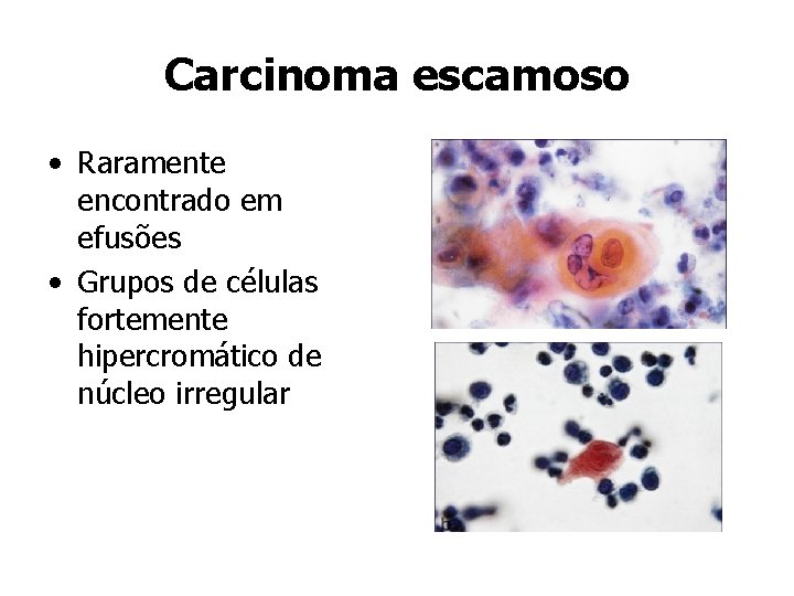 Carcinoma escamoso • Raramente encontrado em efusões • Grupos de células fortemente hipercromático de