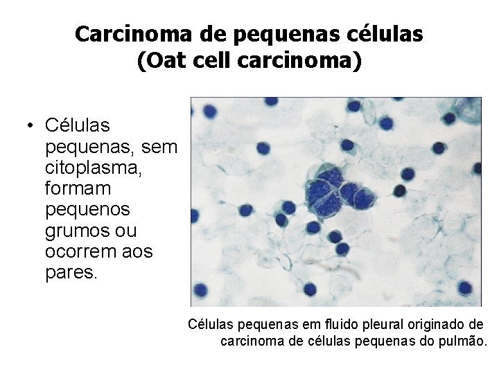 Carcinoma de pequenas células (Oat cell carcinoma) • Células pequenas, sem citoplasma, formam pequenos