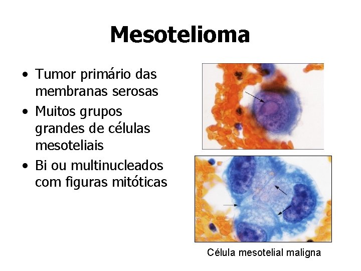 Mesotelioma • Tumor primário das membranas serosas • Muitos grupos grandes de células mesoteliais