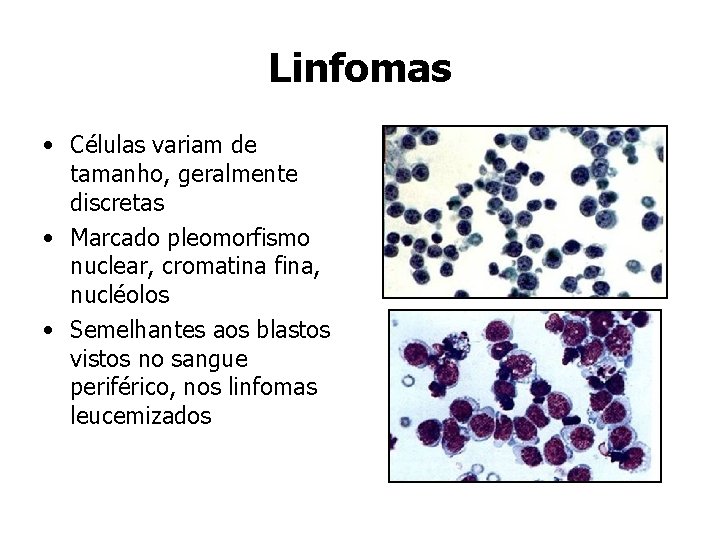 Linfomas • Células variam de tamanho, geralmente discretas • Marcado pleomorfismo nuclear, cromatina fina,