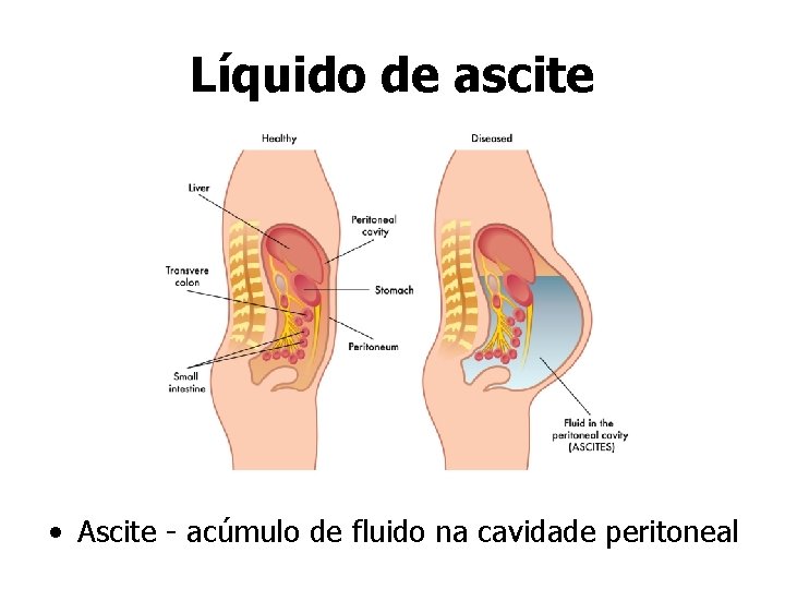 Líquido de ascite • Ascite - acúmulo de fluido na cavidade peritoneal 
