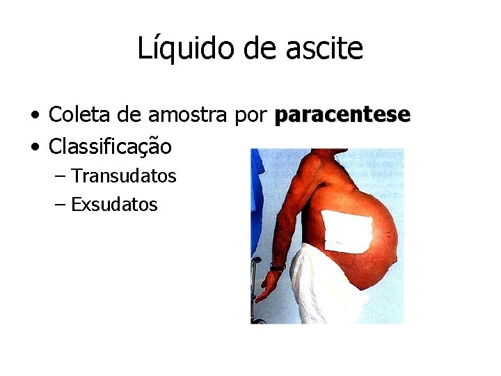 Líquido de ascite • Coleta de amostra por paracentese • Classificação – Transudatos –