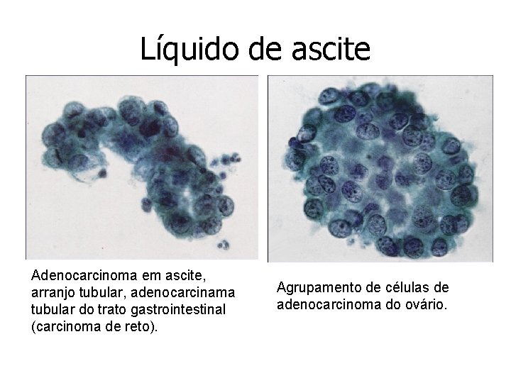 Líquido de ascite Adenocarcinoma em ascite, arranjo tubular, adenocarcinama tubular do trato gastrointestinal (carcinoma