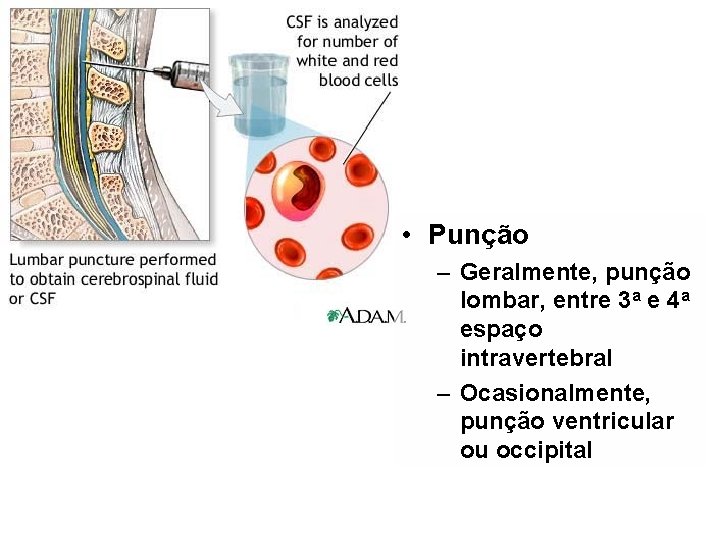  • Punção – Geralmente, punção lombar, entre 3 a e 4 a espaço