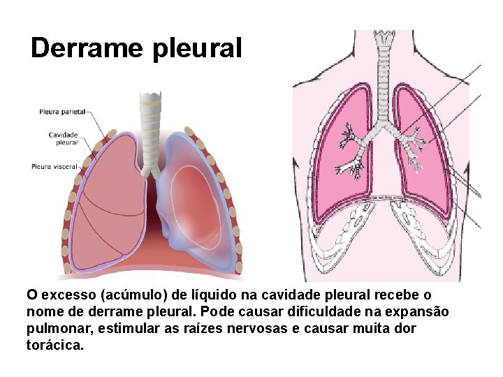 Derrame pleural O excesso (acúmulo) de líquido na cavidade pleural recebe o nome de