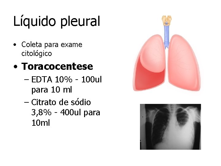 Líquido pleural • Coleta para exame citológico • Toracocentese – EDTA 10% - 100