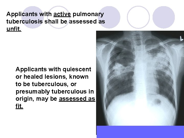 Applicants with active pulmonary tuberculosis shall be assessed as unfit. Applicants with quiescent or