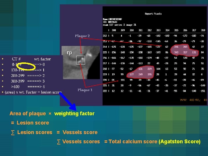 Area of plaque × weighting factor = Lesion score ∑ Lesion scores = Vessels