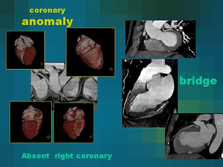 coronary anomaly bridge Absent right coronary 