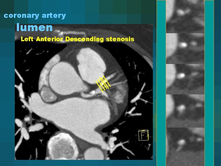 coronary artery lumen Left Anterior Descending stenosis 