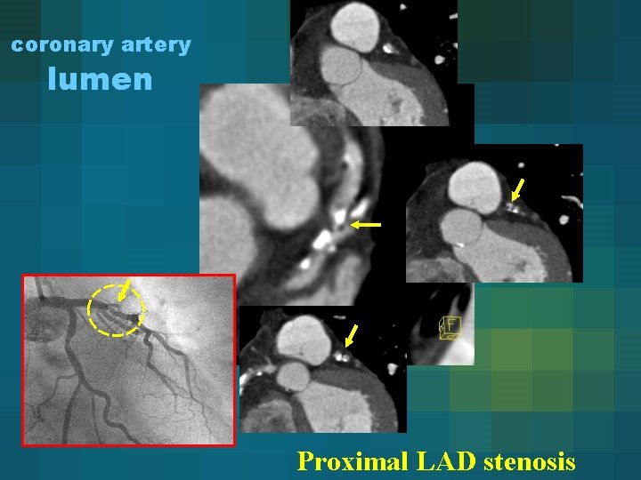 coronary artery lumen Proximal LAD stenosis 