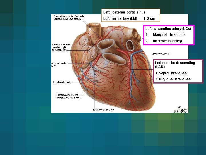 Left posterior aortic sinus Left main artery (LM) -- 1 - 2 cm Left