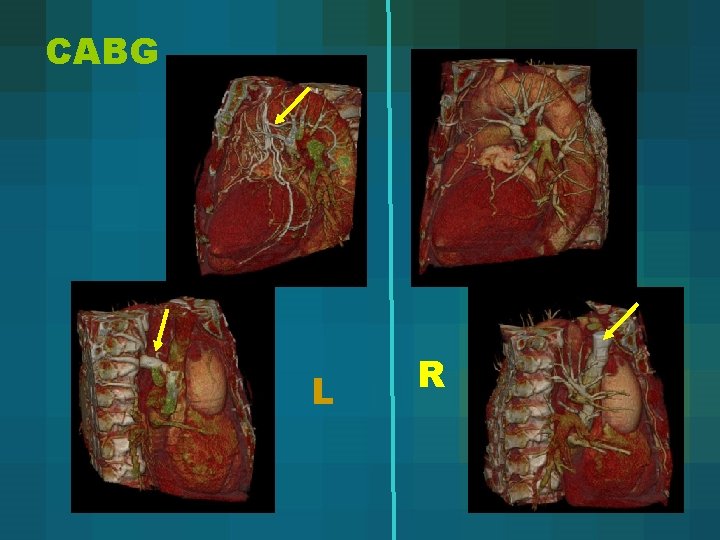 CABG L R 