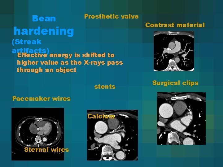 Bean Prosthetic valve Contrast material hardening (Streak artifacts) Effective energy is shifted to higher