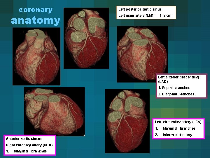 coronary anatomy Left posterior aortic sinus Left main artery (LM) -- 1 - 2