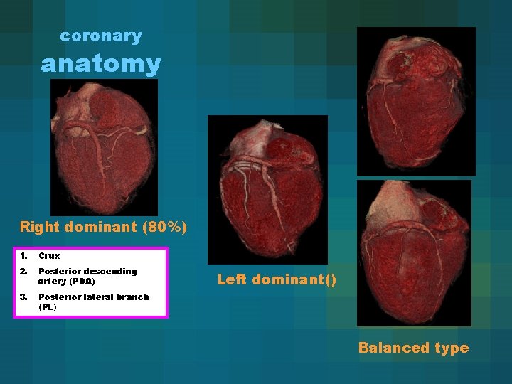 coronary anatomy Right dominant (80%) 1. Crux 2. Posterior descending artery (PDA) 3. Posterior