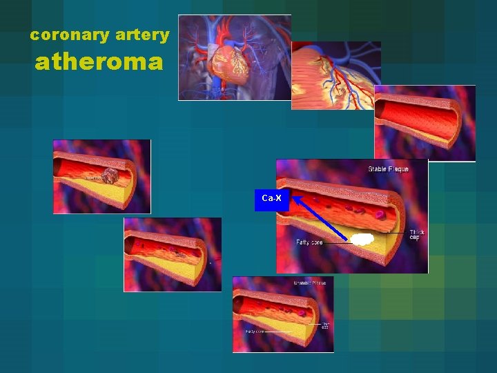 coronary artery atheroma Ca-X 