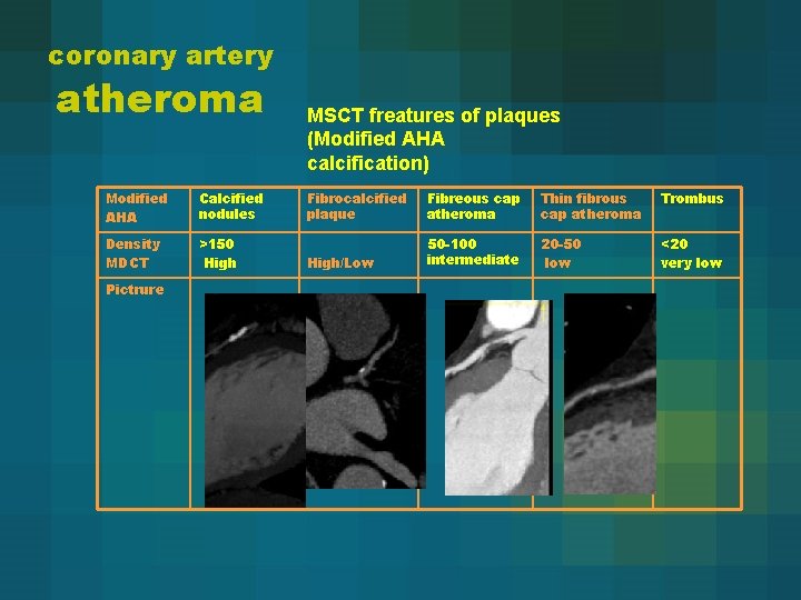 coronary artery atheroma Modified AHA Calcified nodules Density MDCT >150 High Pictrure MSCT freatures