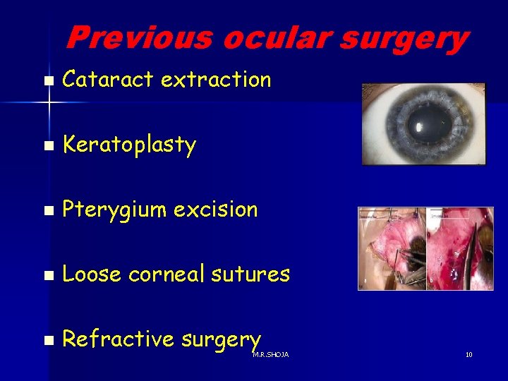 Previous ocular surgery n Cataract extraction n Keratoplasty n Pterygium excision n Loose corneal