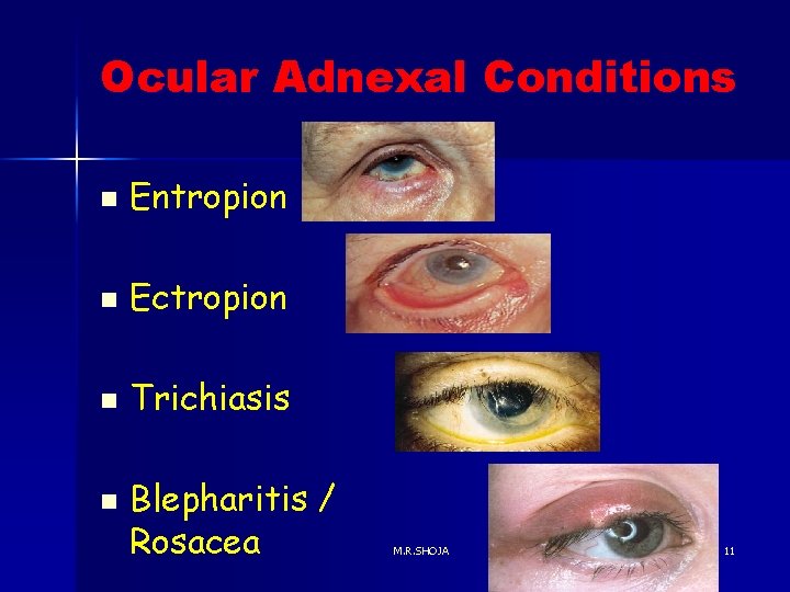 Ocular Adnexal Conditions n Entropion n Ectropion n Trichiasis n Blepharitis / Rosacea M.