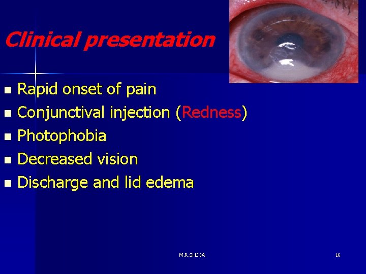 Clinical presentation Rapid onset of pain n Conjunctival injection (Redness) n Photophobia n Decreased