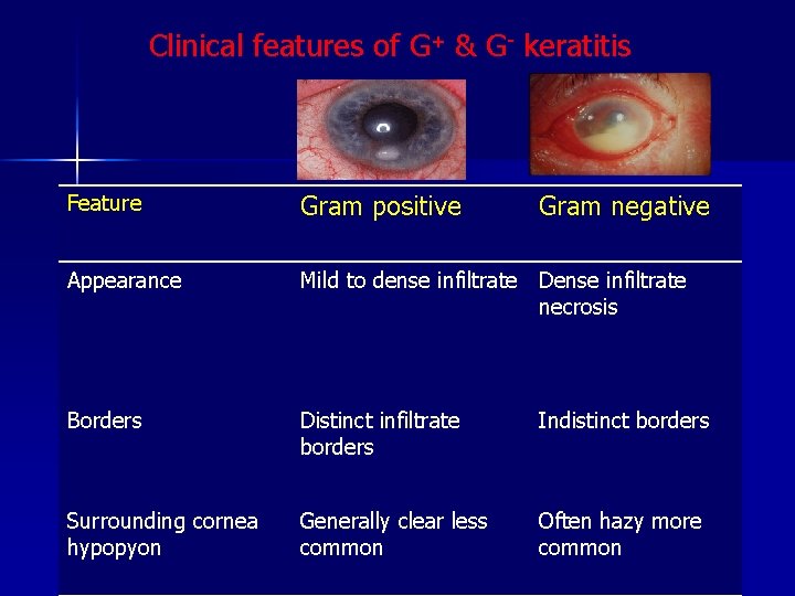 Clinical features of G+ & G- keratitis Feature Gram positive Gram negative Appearance Mild