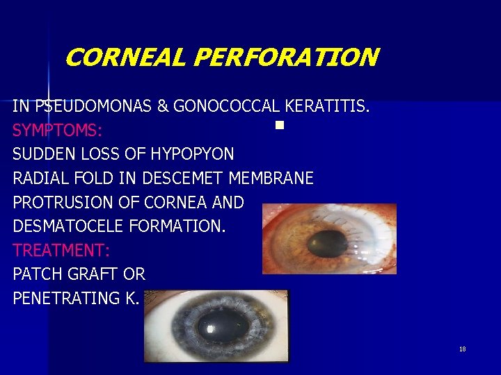 CORNEAL PERFORATION IN PSEUDOMONAS & GONOCOCCAL KERATITIS. n SYMPTOMS: SUDDEN LOSS OF HYPOPYON RADIAL CORNEAL PERFORATION IN PSEUDOMONAS & GONOCOCCAL KERATITIS. n SYMPTOMS: SUDDEN LOSS OF HYPOPYON RADIAL