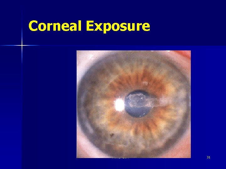 Corneal Exposure M. R. SHOJA 31 