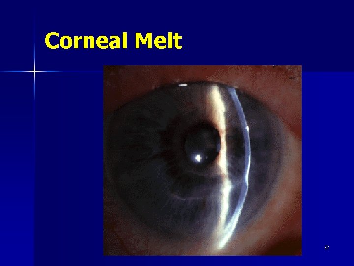 Corneal Melt M. R. SHOJA 32 