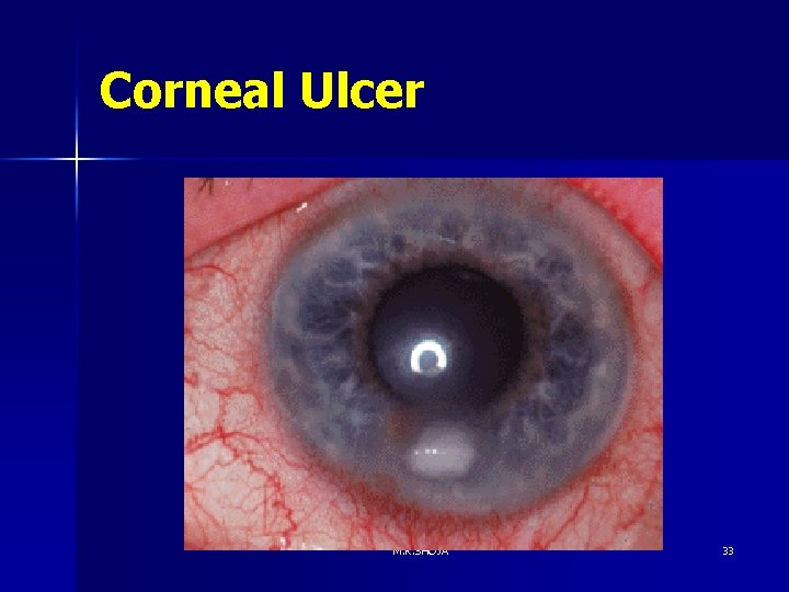 Corneal Ulcer M. R. SHOJA 33 