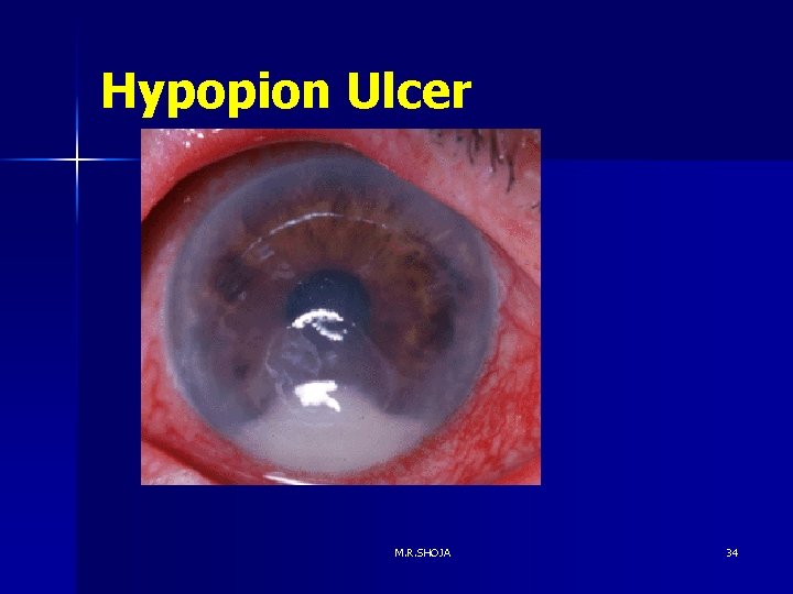 Hypopion Ulcer M. R. SHOJA 34 Hypopion Ulcer M. R. SHOJA 34