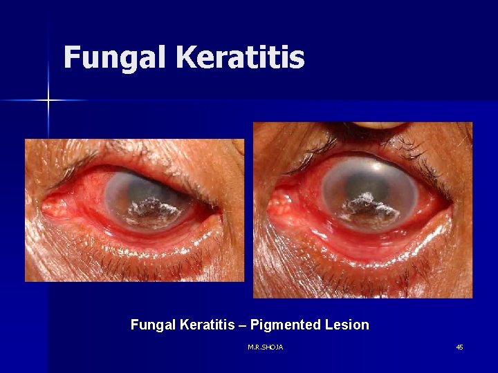 Fungal Keratitis – Pigmented Lesion M. R. SHOJA 45 