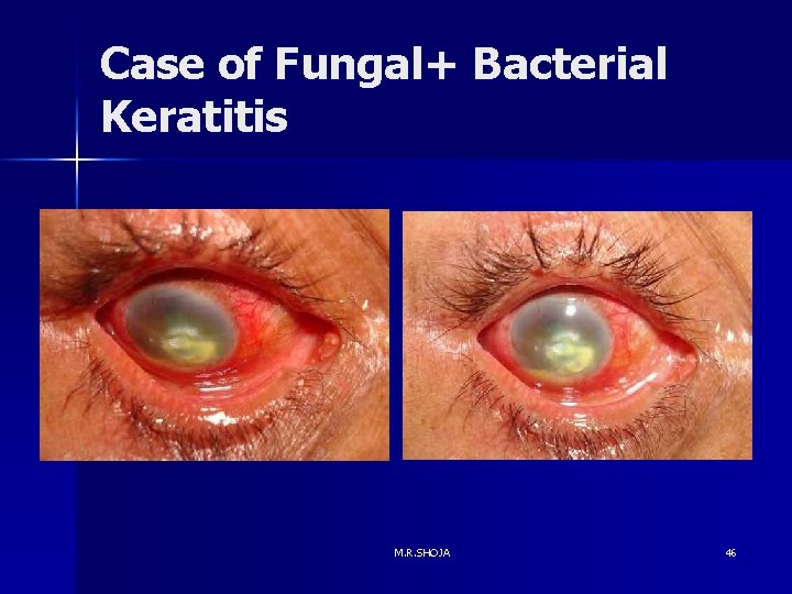 Case of Fungal+ Bacterial Keratitis M. R. SHOJA 46 