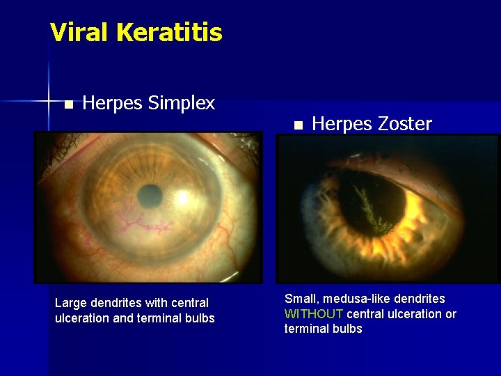 Viral Keratitis n Herpes Simplex n Large dendrites with central ulceration and terminal bulbs