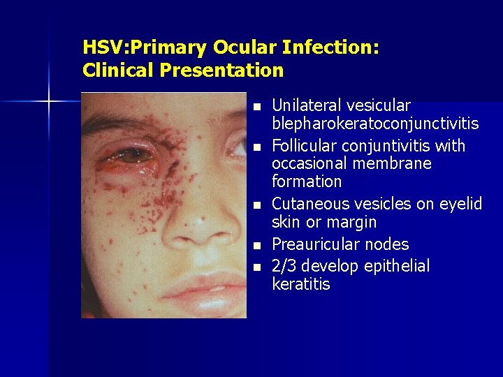 HSV: Primary Ocular Infection: Clinical Presentation n n Unilateral vesicular blepharokeratoconjunctivitis Follicular conjuntivitis with