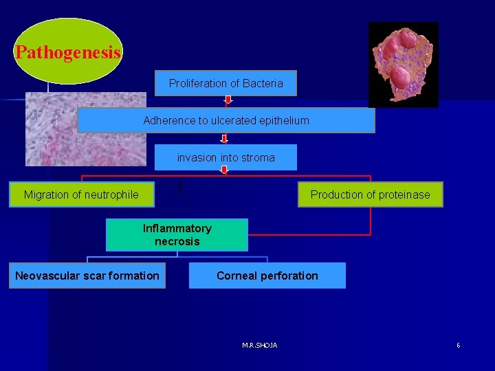 Pathogenesis Proliferation of Bacteria Adherence to ulcerated epithelium invasion into stroma Migration of neutrophile Pathogenesis Proliferation of Bacteria Adherence to ulcerated epithelium invasion into stroma Migration of neutrophile
