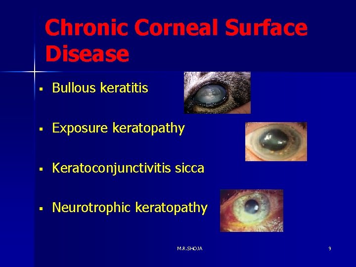 Chronic Corneal Surface Disease § Bullous keratitis § Exposure keratopathy § Keratoconjunctivitis sicca §